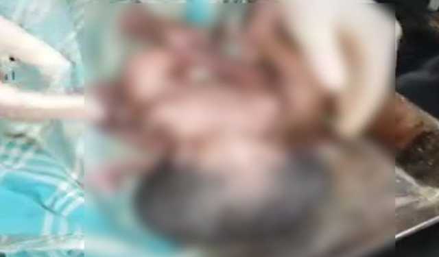 জোড়া মাথার দুই কন্যাশিশুর জন্মের আগেই মৃত্যু