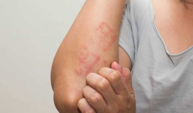 স্ক্যাবিস: চিকিৎসা গ্রহণে সতর্ক হোন