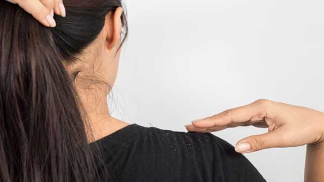 গরমেও মাথা ভর্তি খুশকি? দূর করবেন যেভাবে