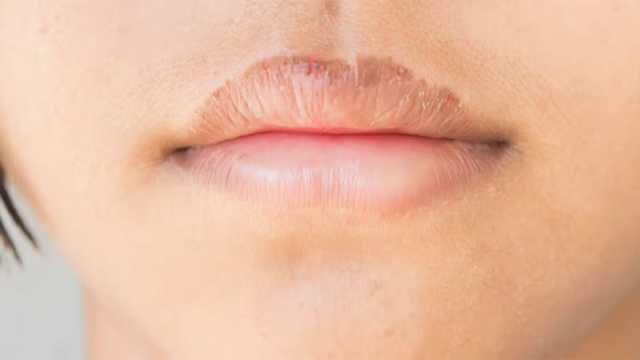 বারবার ঠোঁট ফাটছে? মেনে চলুন ঘরোয়া উপায়