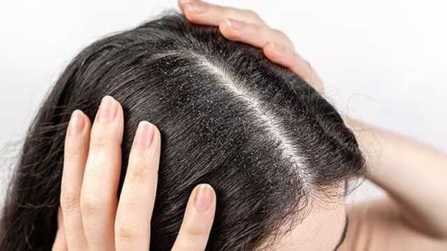 বর্ষায় খুশকির সমস্যা দূর করার ঘরোয়া উপায়