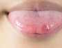 জিহ্বায় ক্ষত হওয়ার ঝুঁকি কাদের বেশি 